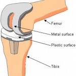 knee-replacement