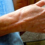 wrist Scars are a constant reminder of the ordeal Susie Risz Laney went through.