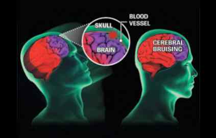 Concussions and the classroom being studied
