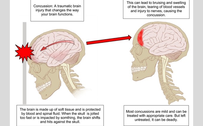 Concussions not just a concern for pro athletes