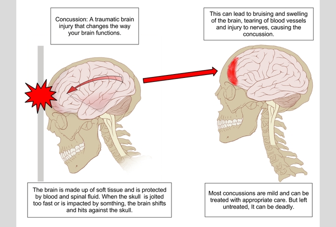 Source: Concussion mechanics.svg